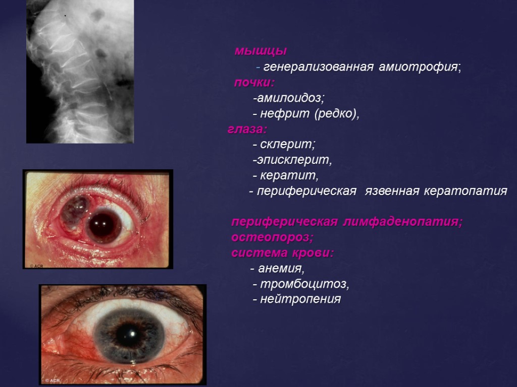 мышцы - генерализованная амиотрофия; почки: -амилоидоз; - нефрит (редко), глаза: - склерит; -эписклерит, -
